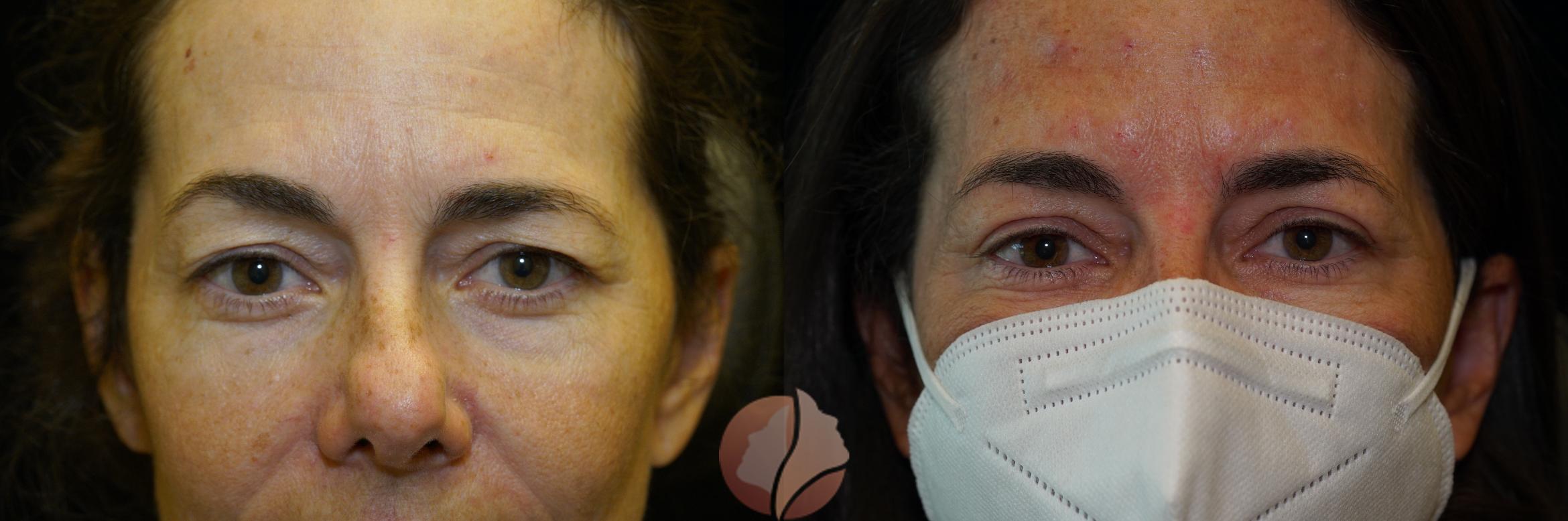 Before & After Upper Blepharoplasty Case 5 Front View in Saratoga, CA