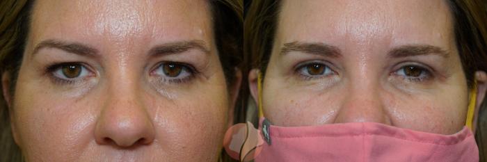 Before & After Upper Blepharoplasty Case 6 Front View in Saratoga, CA