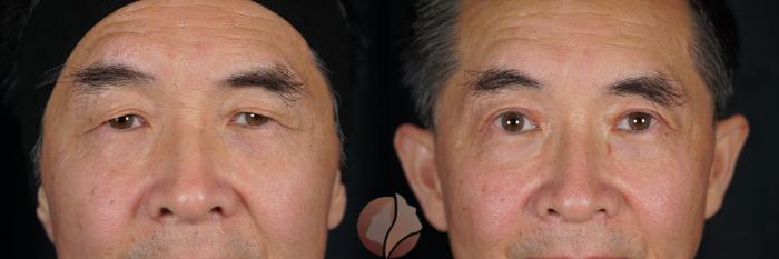 Before & After Upper Blepharoplasty Case 71 Front View in Saratoga, CA