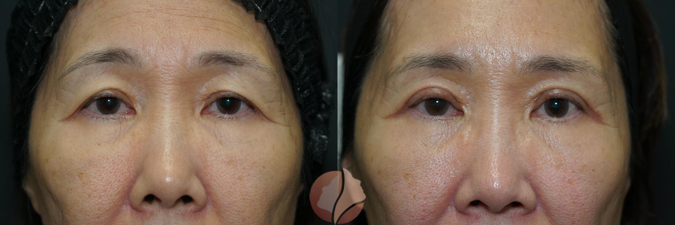 Before & After Upper Blepharoplasty Case 73 Front View in Saratoga, CA