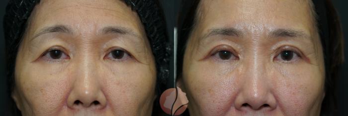 Before & After Brow Lift Case 73 Front View in Saratoga, CA