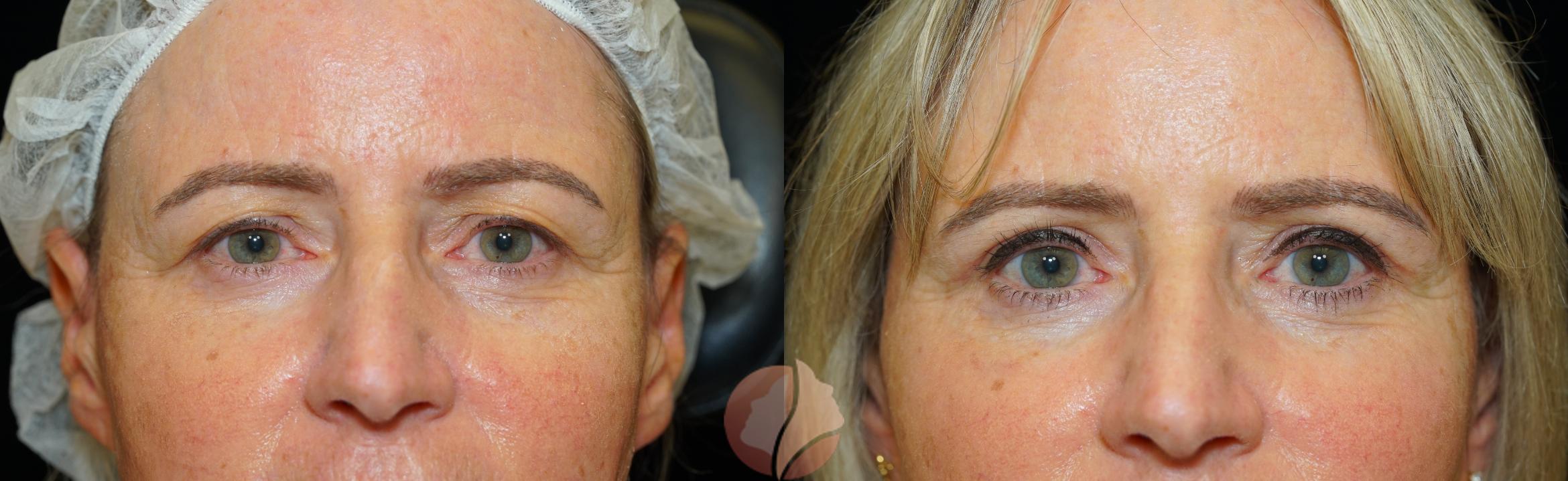 Before & After Upper Blepharoplasty Case 74 Front View in Saratoga, CA