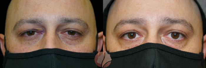 Before & After Xanthelasma  Case 142 Front View in Saratoga, CA