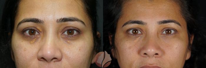 Before & After Xanthelasma  Case 143 Front View in Saratoga, CA